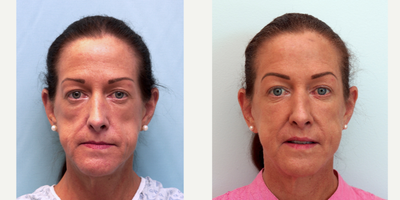 Facial Fat Transfer before and after photo