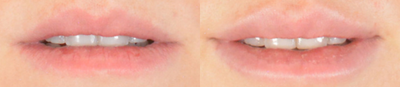 Lip Fillers before and after photo