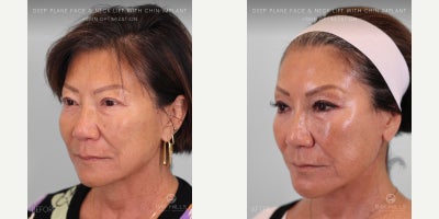 Neck Lift before and after photo