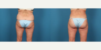 Brazilian Butt Lift before and after photo