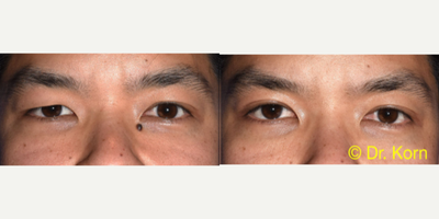 Double Eyelid Surgery before and after photo