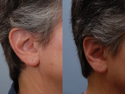 Ear Surgery before and after photo