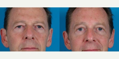 Eyelid Surgery before and after photo