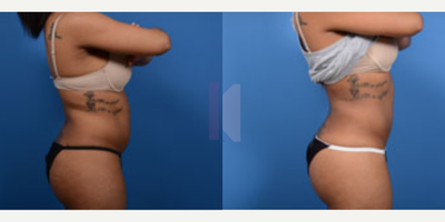 Liposuction before and after photo