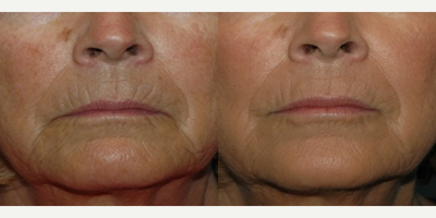 Restylane Silk before and after photo