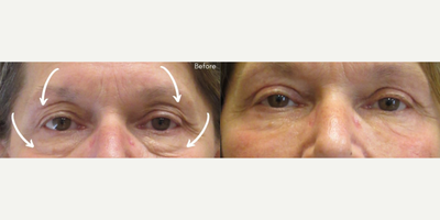 Sculptra before and after photo