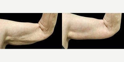 Arm Lift before and after photo