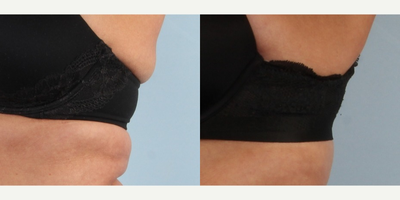 CoolSculpting before and after photo