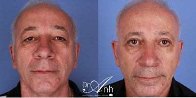 Eyelid Surgery before and after photo