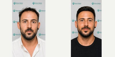 FUE Hair Transplant before and after photo