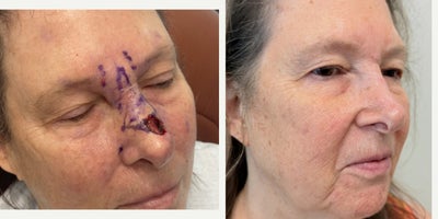 Mohs Surgery before and after photo