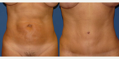 Tummy Tuck before and after photo