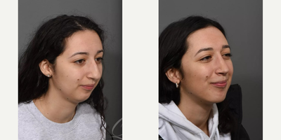 Chin Implant before and after photo
