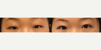 Eyelid Surgery before and after photo