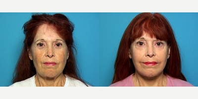 Facelift before and after photo