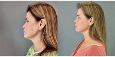 Facial Fat Transfer before and after photo