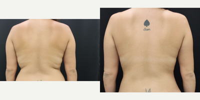 Liposuction before and after photo