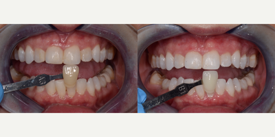 Teeth Whitening before and after photo