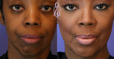 Chin Implant before and after photo