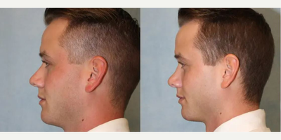 Rhinoplasty before and after photo