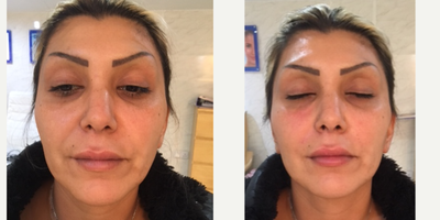 Vollure before and after photo