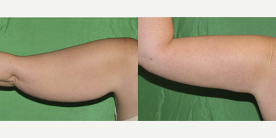 Laser Liposuction before and after photo