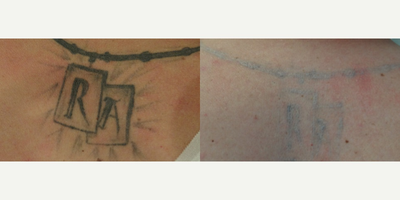 Tattoo Removal before and after photo
