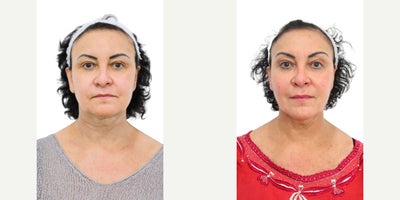 Thread Lift before and after photo