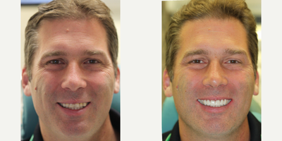 Tooth Repair before and after photo