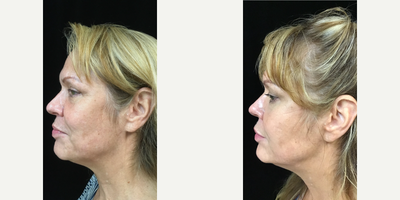 Voluma before and after photo