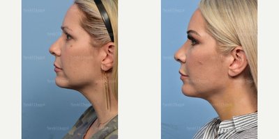 Chin Liposuction before and after photo