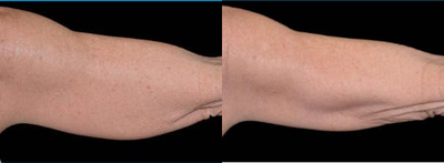 CoolSculpting before and after photo