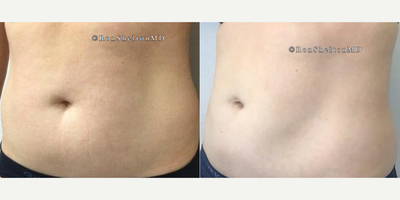 CoolSculpting before and after photo