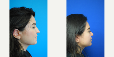 Dermal Fillers before and after photo