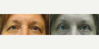 Eyelid Surgery before and after photo