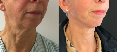 Facelift before and after photo