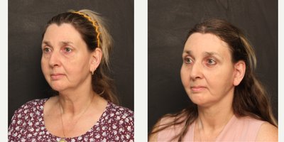 Facelift before and after photo