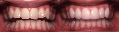 Porcelain Veneers before and after photo