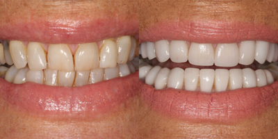 Porcelain Veneers before and after photo