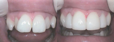 Smile Makeover before and after photo