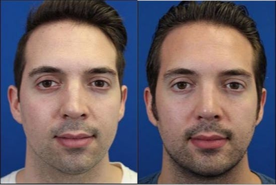 Chin Implant before and after photo