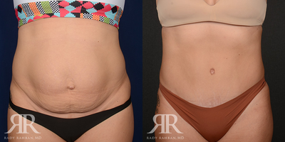 Diastasis Recti Repair before and after photo