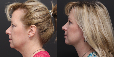 Neck Lift before and after photo