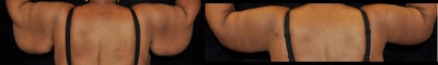 Arm Lift before and after photo