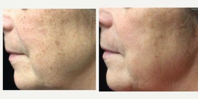 Chemical Peel before and after photo