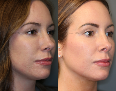 Dermal Fillers before and after photo