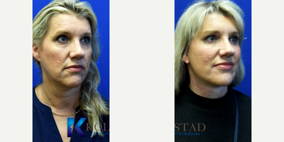 Facelift before and after photo