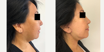 Facelift before and after photo