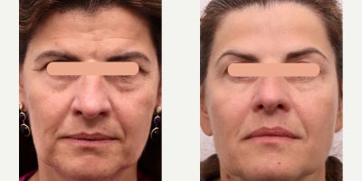 Botox before and after photo