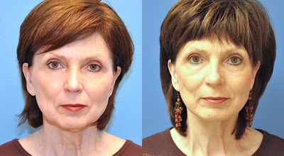 Facelift before and after photo
